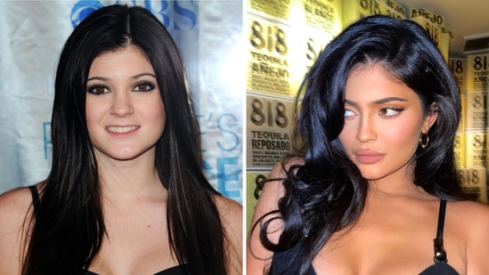 kylie-jenner-plastic-surgery-1744268434.jpg